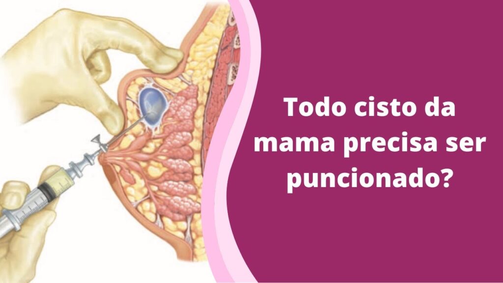 Cisto na mama: O que é, quais são as causas e o tratamento? 1 Cisto na mama