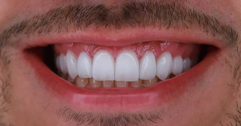 Transformando Sorrisos com Lentes de Porcelana: Um Guia Completo 1 Lentes de Porcelana